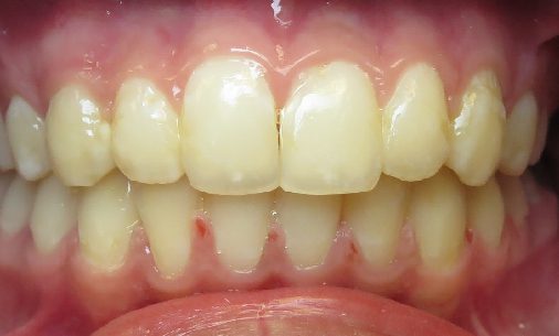 after111 Abari Orthodontics and Oral Surgery - before & after