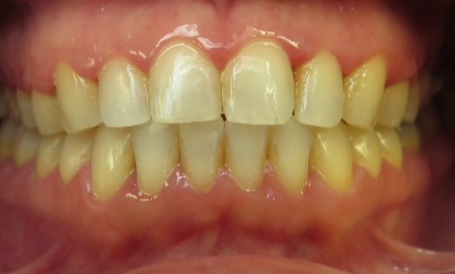 after12 Abari Orthodontics and Oral Surgery - before & after