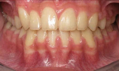 after3 Abari Orthodontics and Oral Surgery - before & after