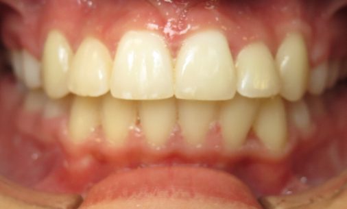 after4 Abari Orthodontics and Oral Surgery - before & after