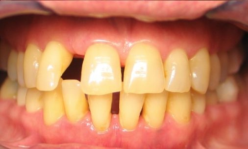 before10 Abari Orthodontics and Oral Surgery - before & after