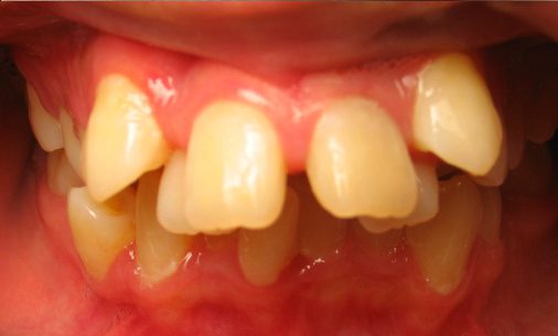 before11 Abari Orthodontics and Oral Surgery - before & after