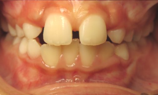 before4 Abari Orthodontics and Oral Surgery - before & after