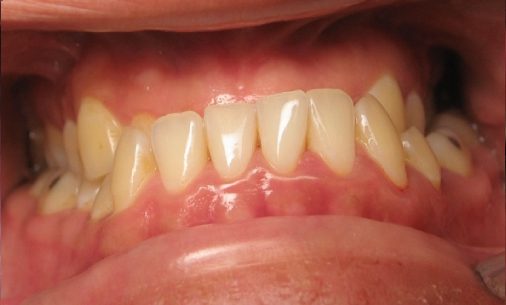before9 Abari Orthodontics and Oral Surgery - before & after