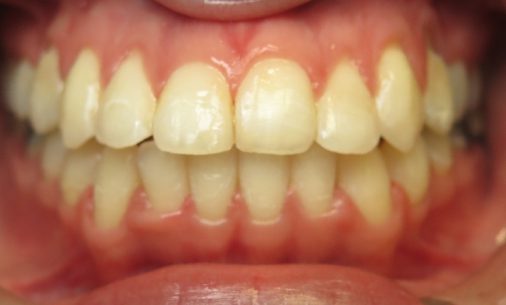 before5 4 Abari Orthodontics and Oral Surgery - before & after
