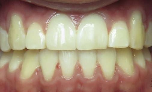 before5 8 Abari Orthodontics and Oral Surgery - before & after