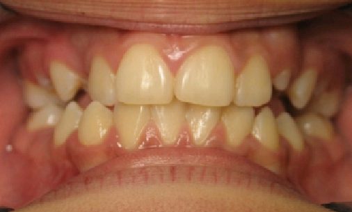 before5 Abari Orthodontics and Oral Surgery - before & after