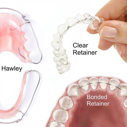 types retainers. pic 1 Abari Orthodontics and Oral Surgery