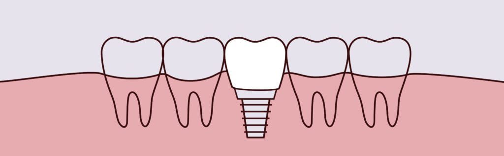 dental implants to restore your smile in san dimas ca