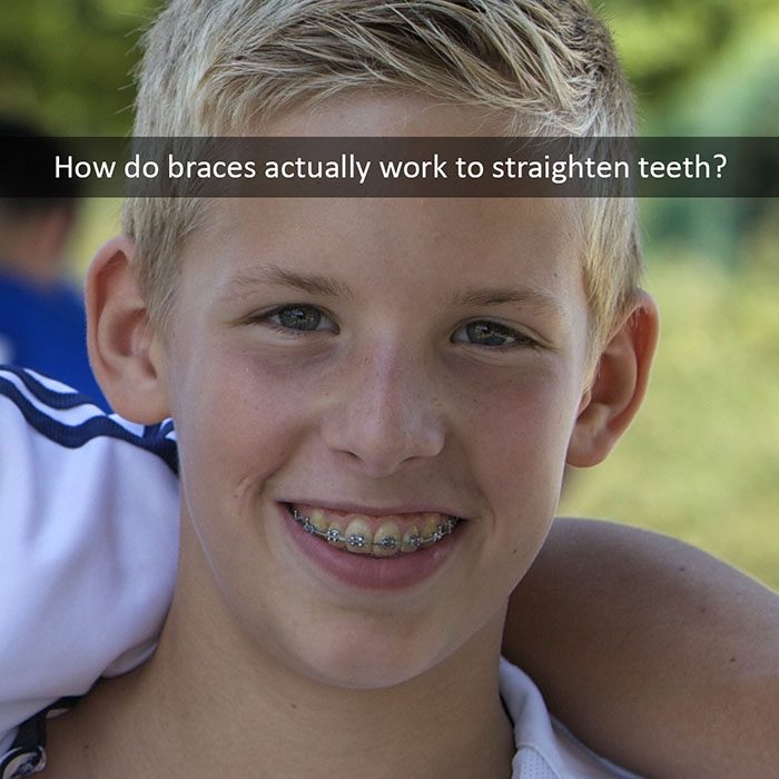 how braces work 2022 700 Abari Orthodontics and Oral Surgery