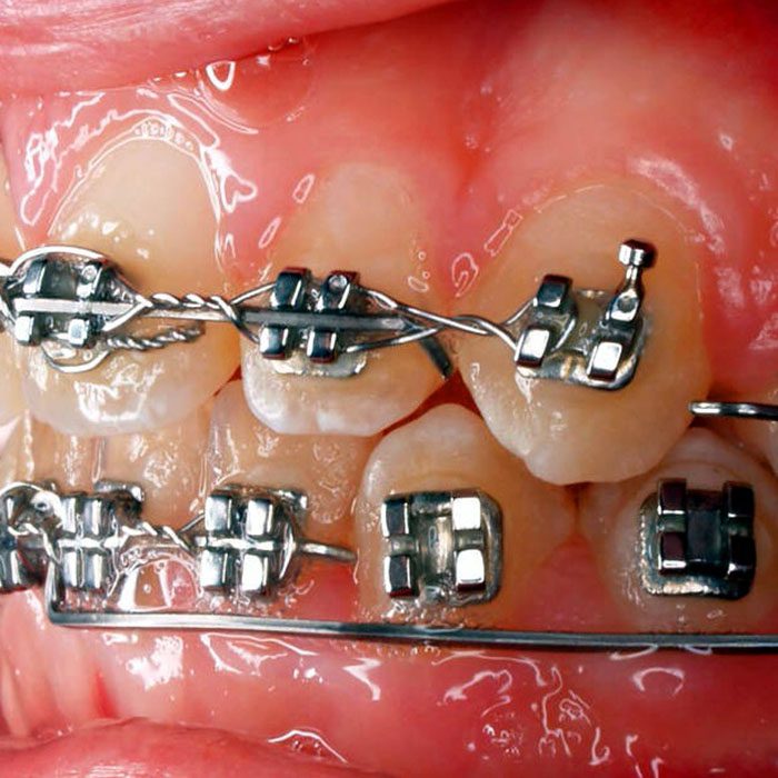braces anatomy 2022 700 Abari Orthodontics and Oral Surgery -