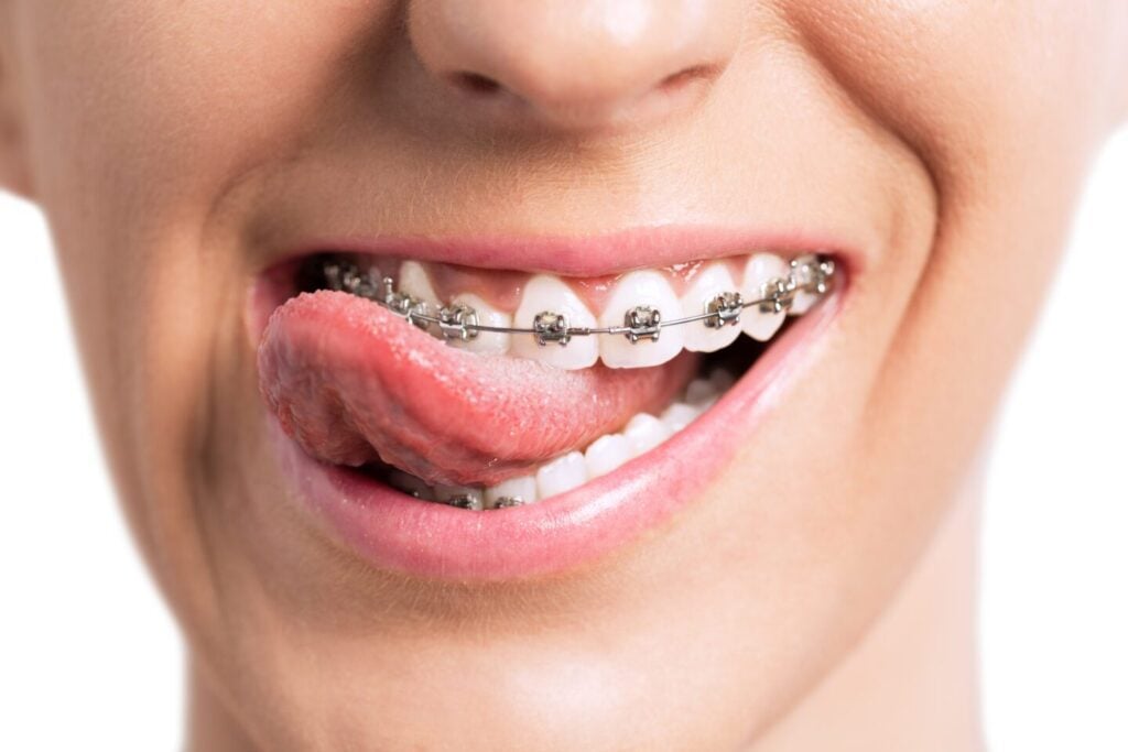 braces near me in san dimas
