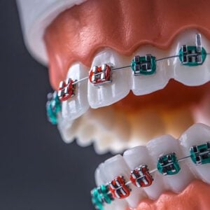 Braces near me orthodontist
