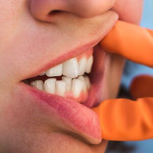 orthodontist san dimas