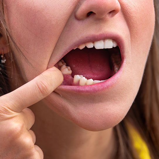 dental implants san dimas ca