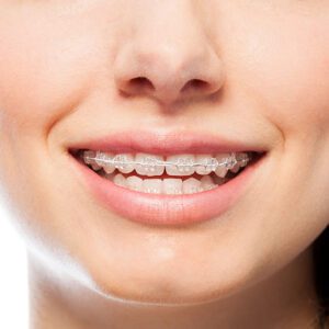 clear braces san dimas clear braces near me
