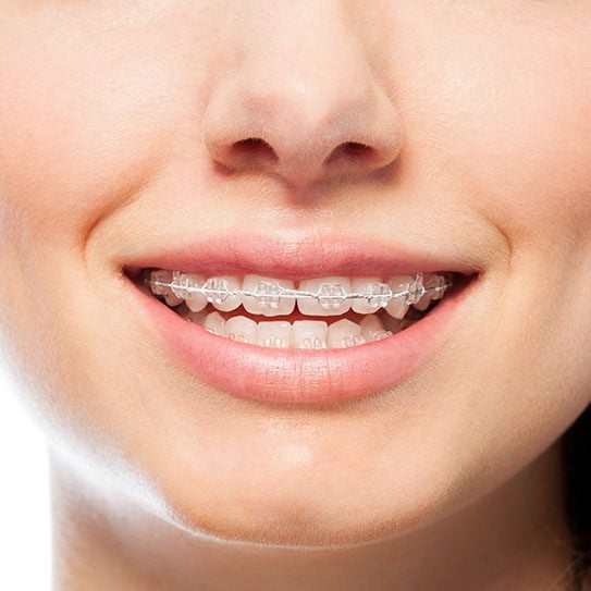 clear braces san dimas clear braces near me