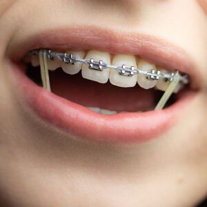 orthodontist san dimas