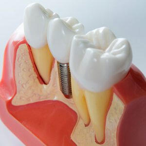 dental implant san dimas dental implants