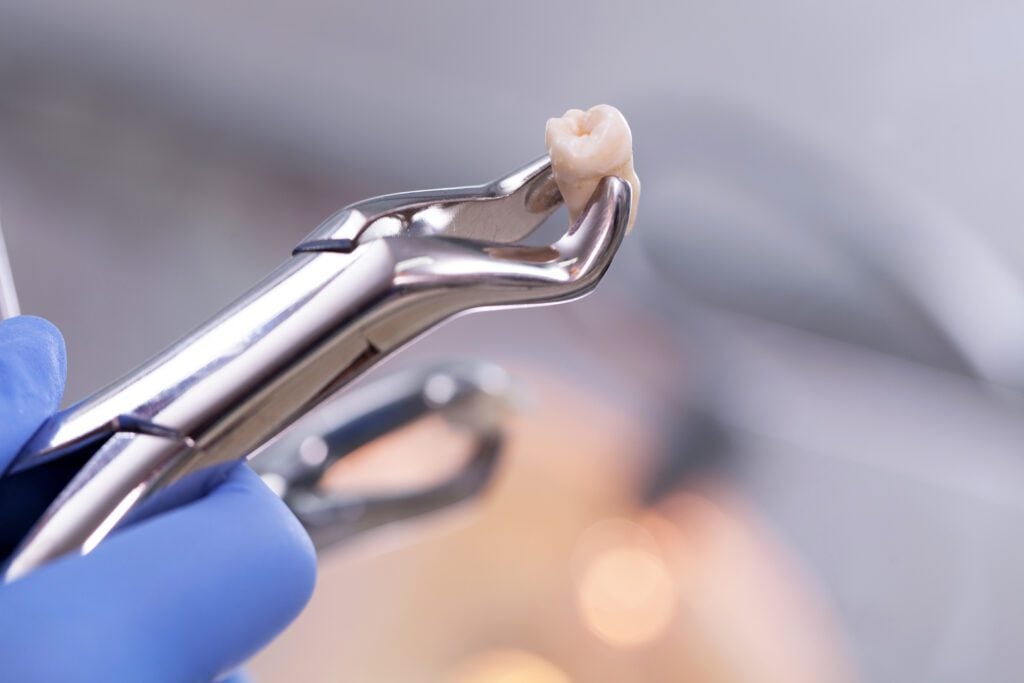 wisdom tooth extraction san dimas