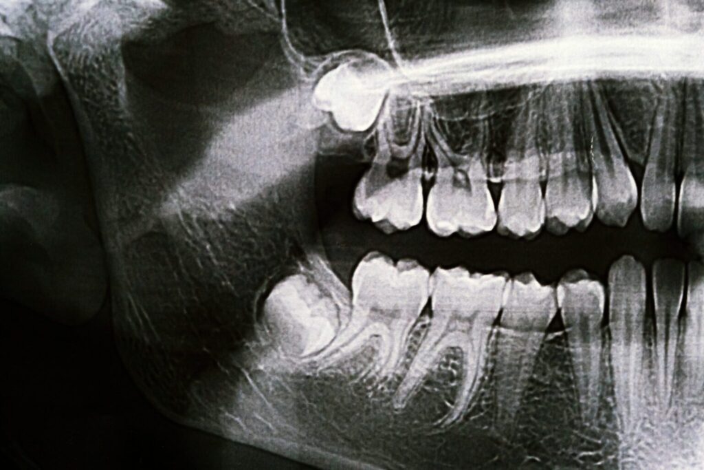 wisdom teeth removal San Dimas