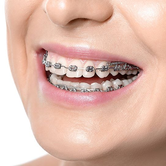orthodontist san dimas