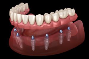 dental implants in San Dimas
