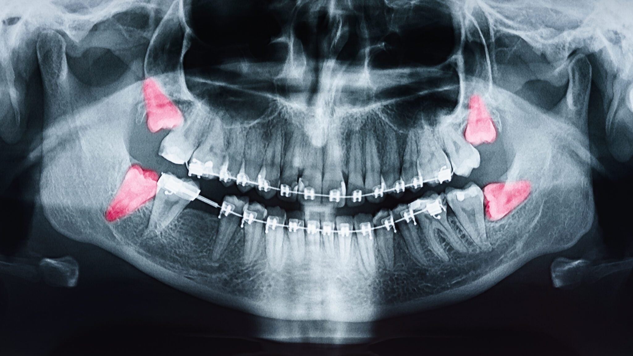 wisdom teeth removal in San Dimas