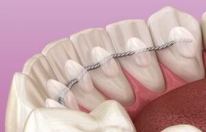 retainer after braces