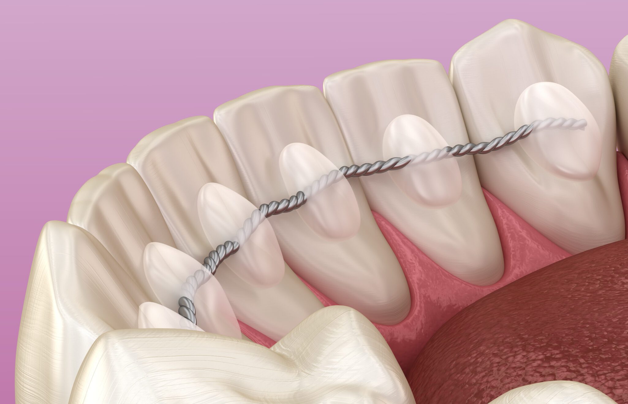 retainer after braces