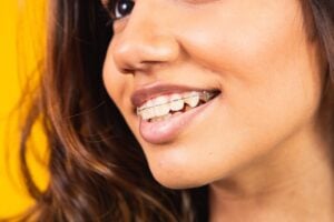 clear braces in San Dimas