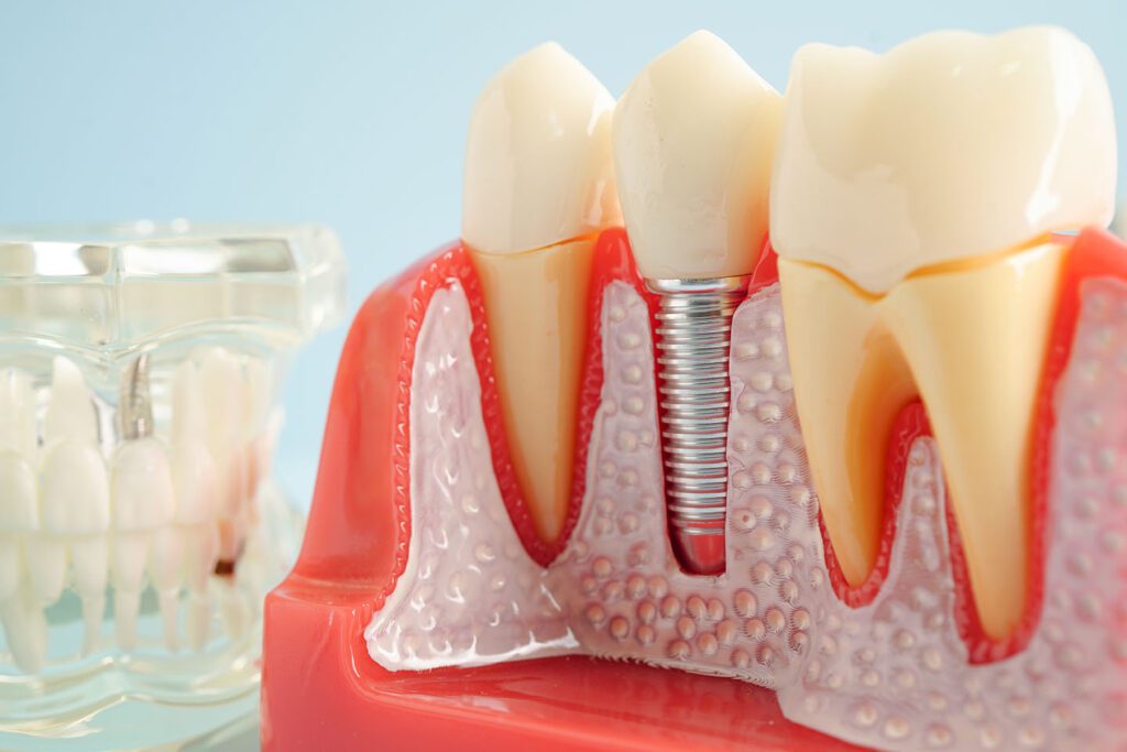 implant surgery in San Dimas